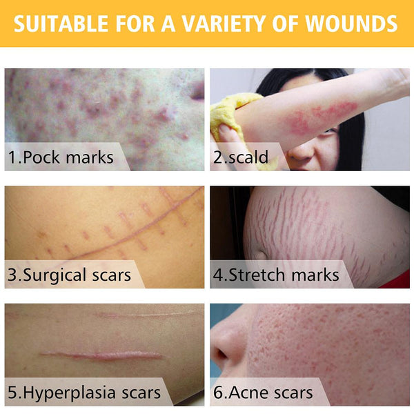 Acne Scar Removal Cream