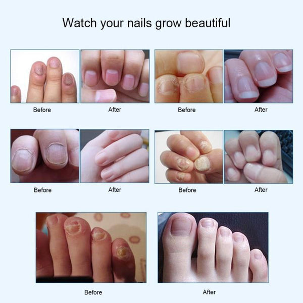 Onychomycosis Fungal Nail Repair Treatment Pen