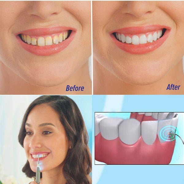 Sonic Tooth Stain Eraser Plaque Remover Teeth Whitening Dental Tool Kit