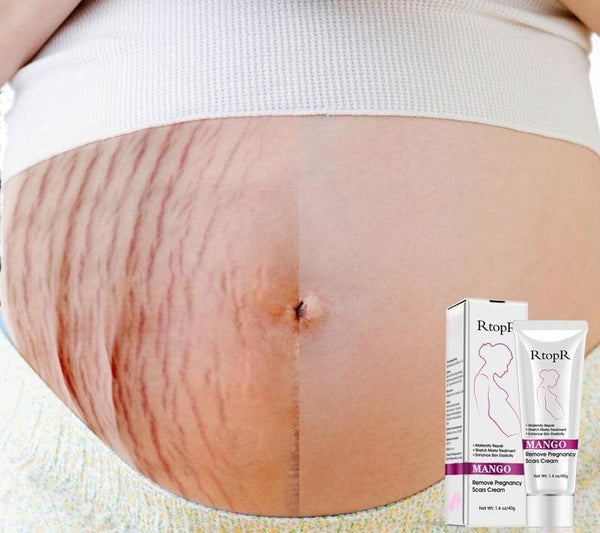 Stretch Mark Removal Cream