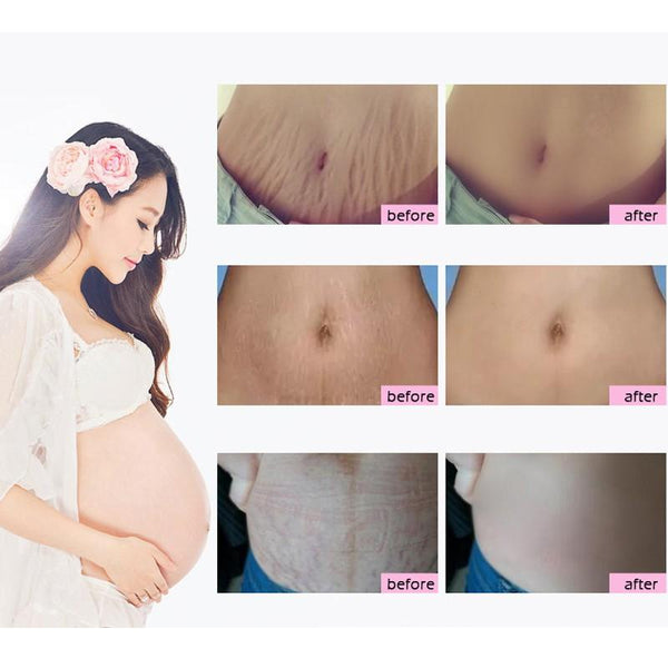 Stretch Mark Removal Cream