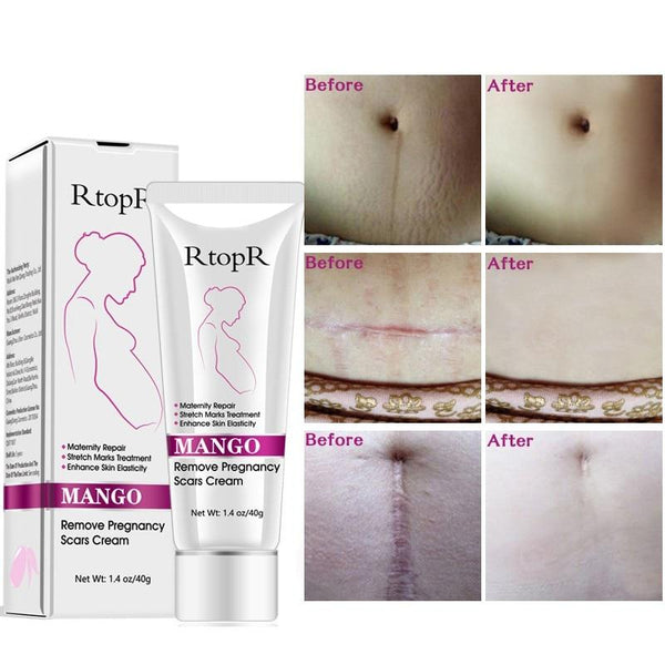Stretch Mark Removal Cream