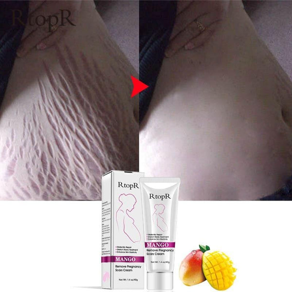 Stretch Mark Removal Cream